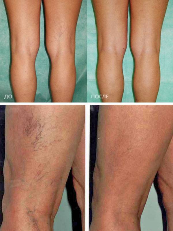 Лечение варикоза вен на ногах лазером, цена операции и отзывы