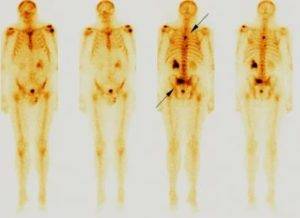 Сцинтиграфия костей скелета – показания, подготовка и результат