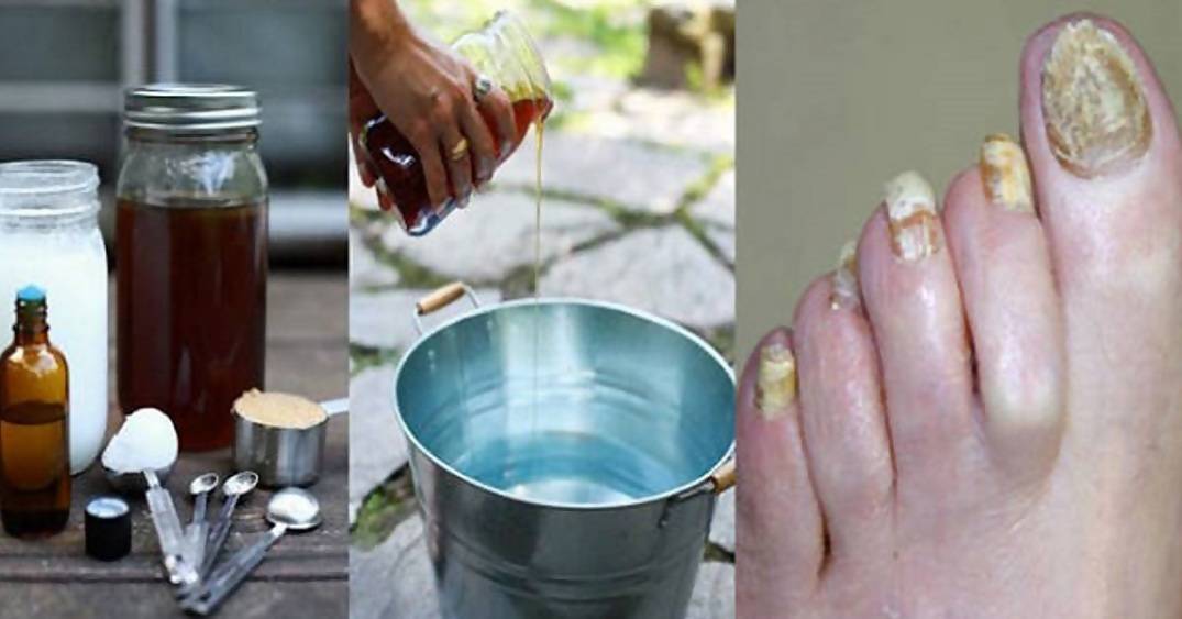Народные средства от грибка ногтей на ногах — лечим быстро и просто