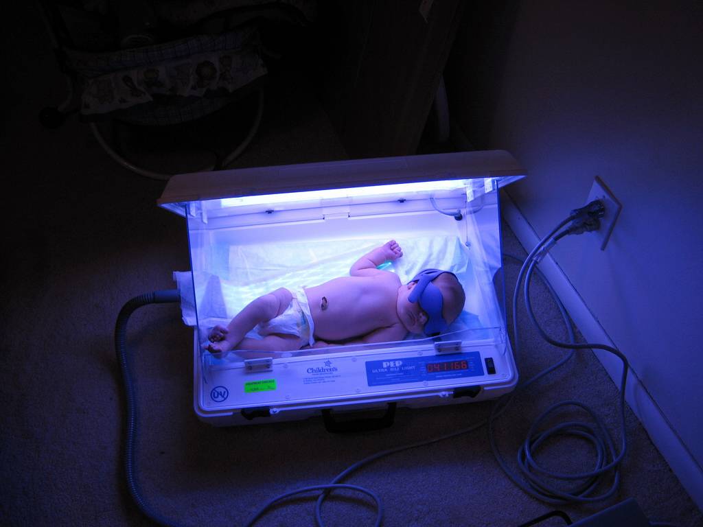 Желтушка у новорожденных: лечение, фототерапия лампой