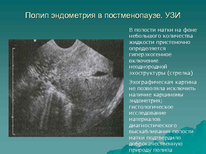 ᐉ серозометра в менопаузе лечение народными средствами - sp-medic.ru