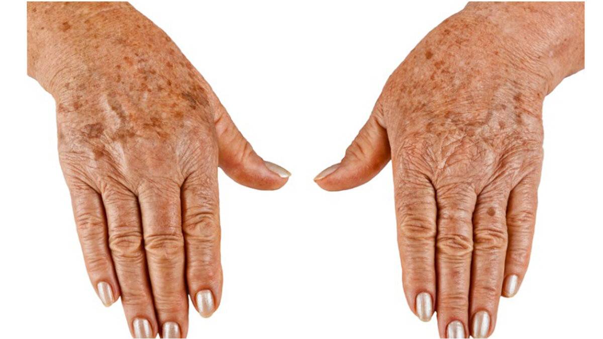 Коричневые пигментные отметины: причины появления на коже рук, способы эффективного удаления пятен