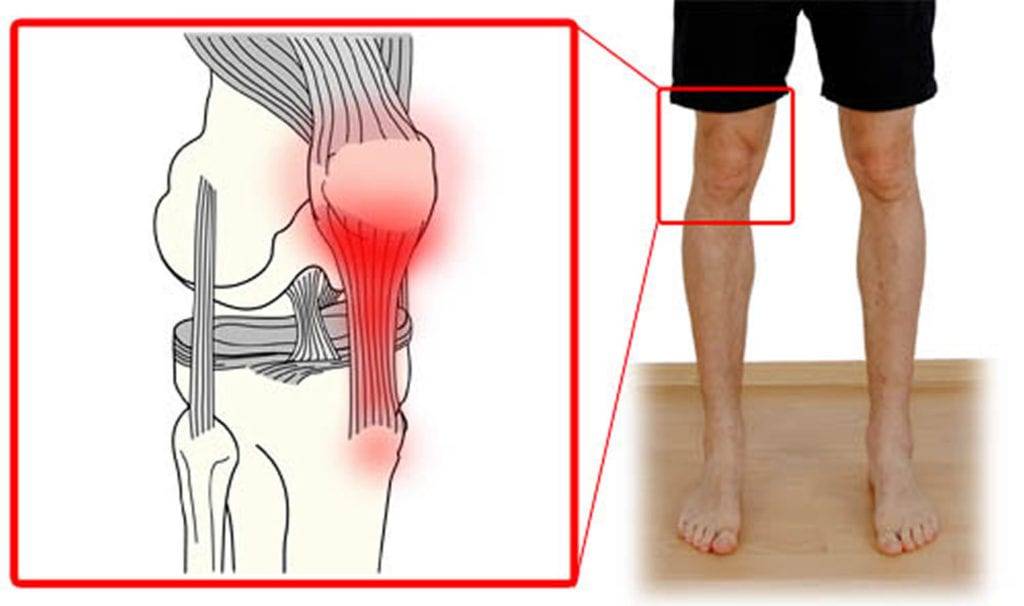 Лечение ноющей боли в коленном суставе