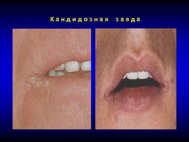 Чем лечить заеды в уголках губ