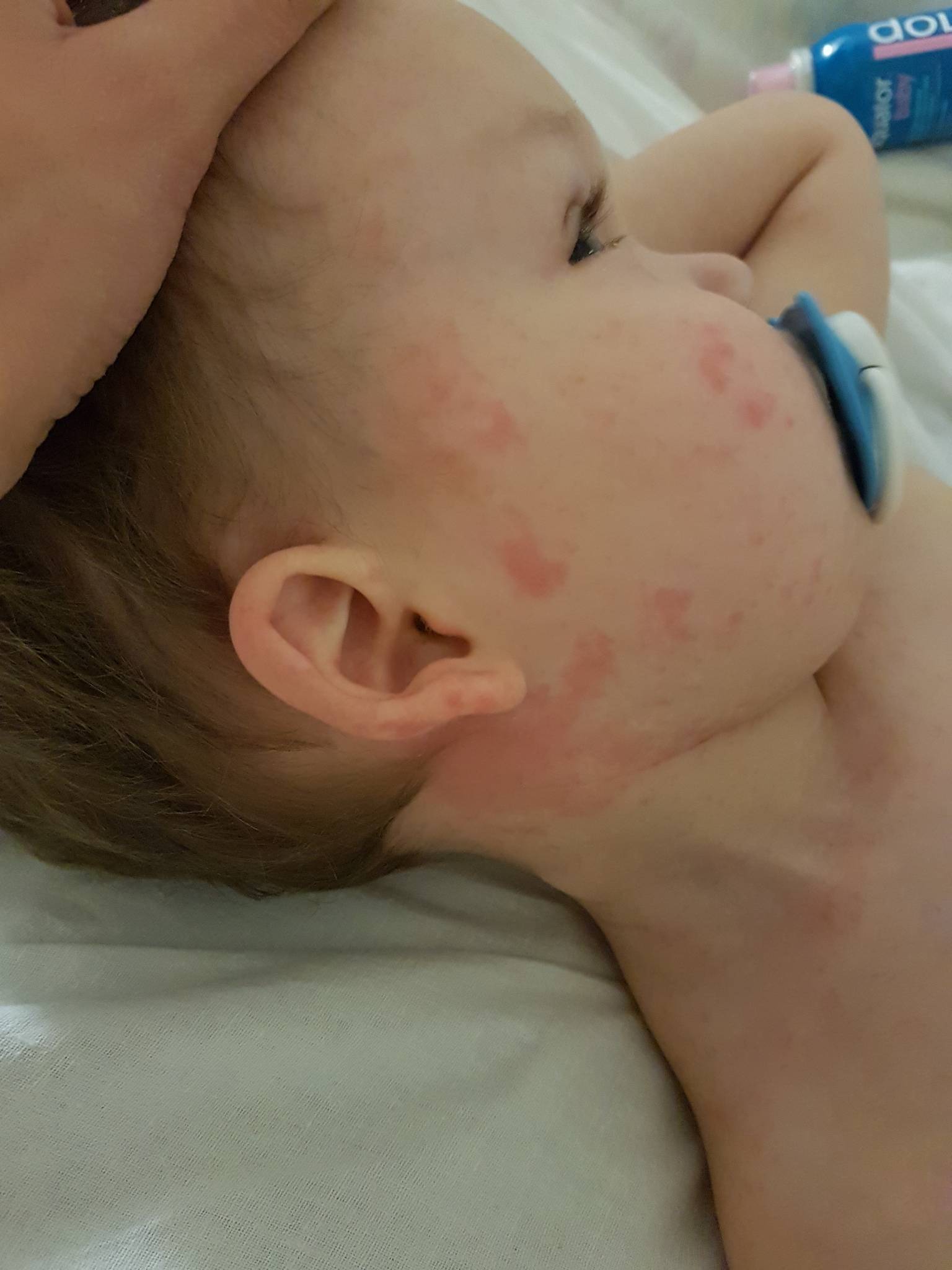 Аллергическая сыпь у детей: причины и методы лечения
