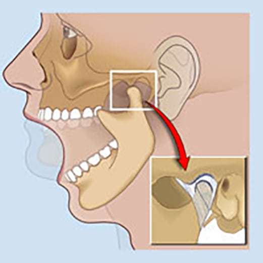 Почему хрустит челюсть при открывании рта: причины и что с этим делать
