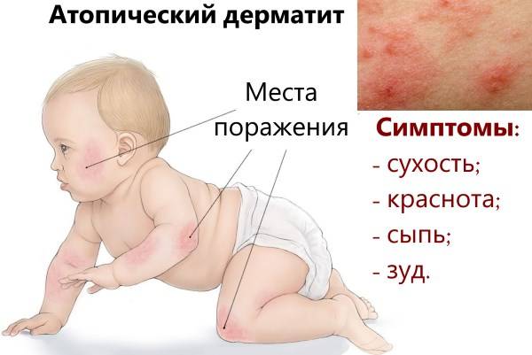 Лечение аллергической сыпи у детей