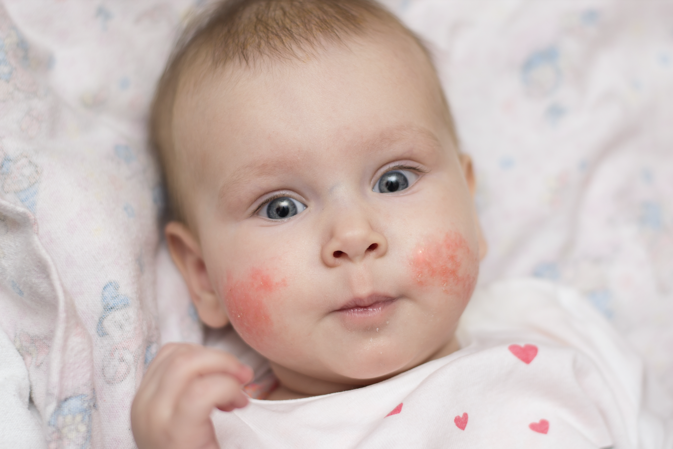 Перианальный дерматит у ребенка лечение — аллергия