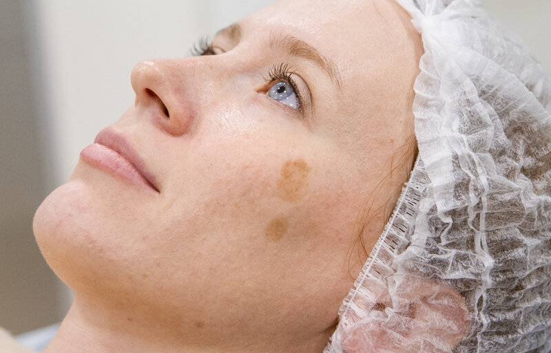 Как избавиться от пигментных пятен на лице: салонные процедуры, отбеливающие кремы и домашние маски