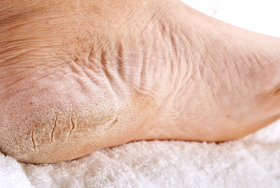 Трещины на стопах ног: причины и методы лечения