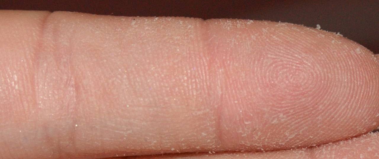 Шелушится кожа на ладонях и пальцах рук: причины с фото и лечение