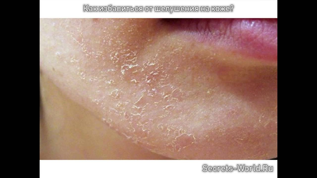 Сухость кожи и зуд по всему телу: причины, лечение шелушения | mfarma.ru