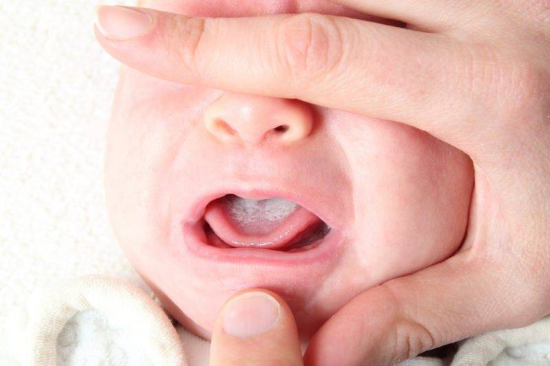 Кандидозный стоматит (молочница во рту). кандидоз языка, миндалин, глотки. лечение взрослых. фото