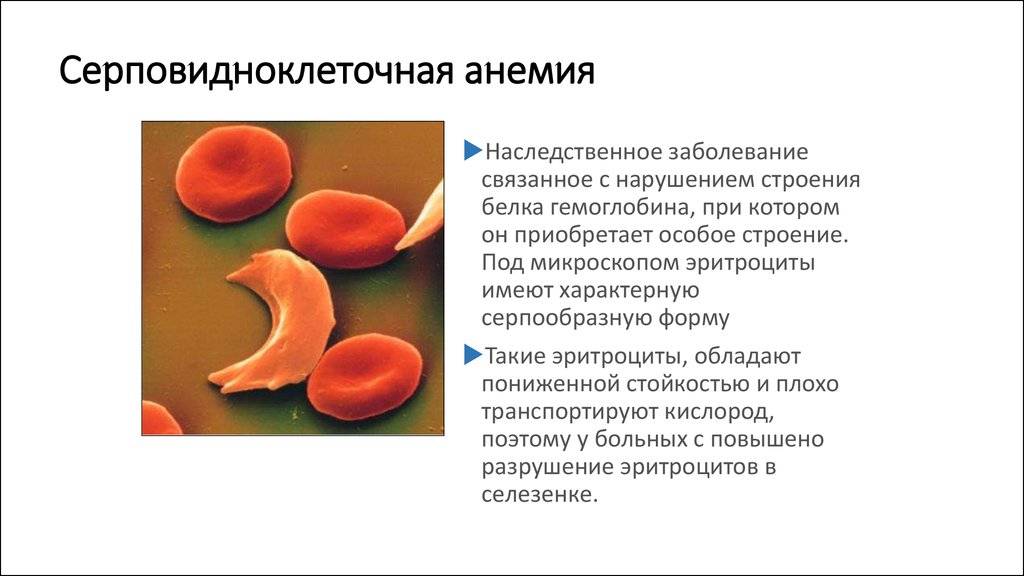 Серповидноклеточная анемия – причины, симптомы, лечение.
