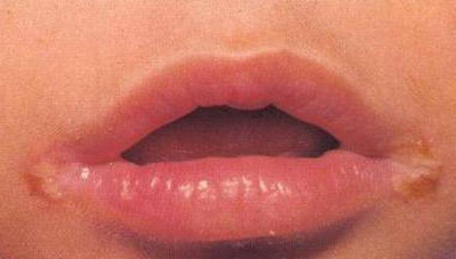 Чем лечить уголки губ быстро: как убрать заеды, трещины и болячки