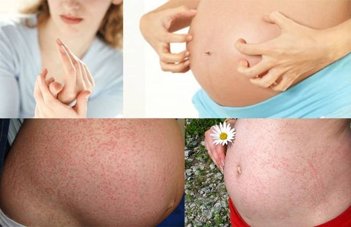 Крапивница как признак беременности • аллергия и аллергические реакции