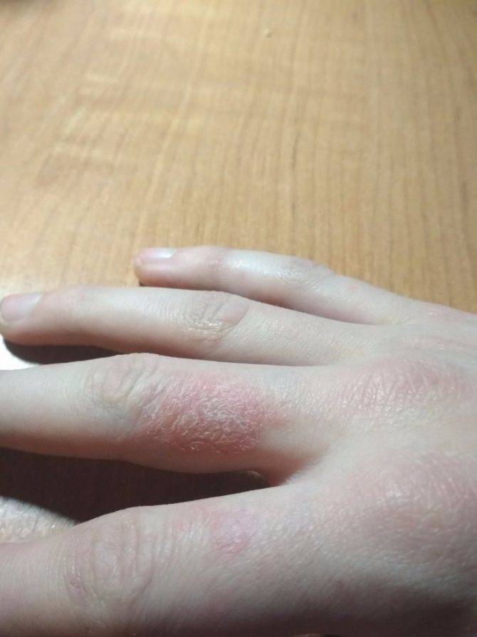 Устраняем покраснение и шелушение кожи между пальцами рук