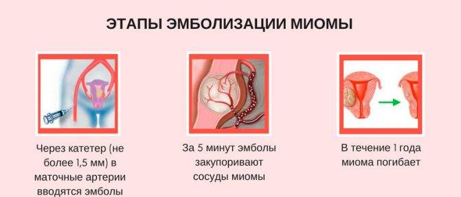 Лечение миомы матки: удаление или эмболизация маточных артерий? миома матки и беременность