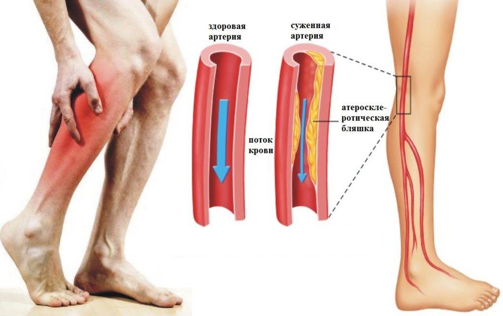 Болит икра на ноге: симптомы и причины возникновения болевого синдрома, лечение дискомфорта в икроножных мышцах