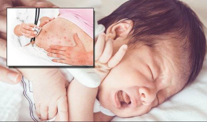 Корь у детей - симптомы и лечение, профилактика (46 фото): признаки, как лечить, инкубационный период, когда появляется сыпь