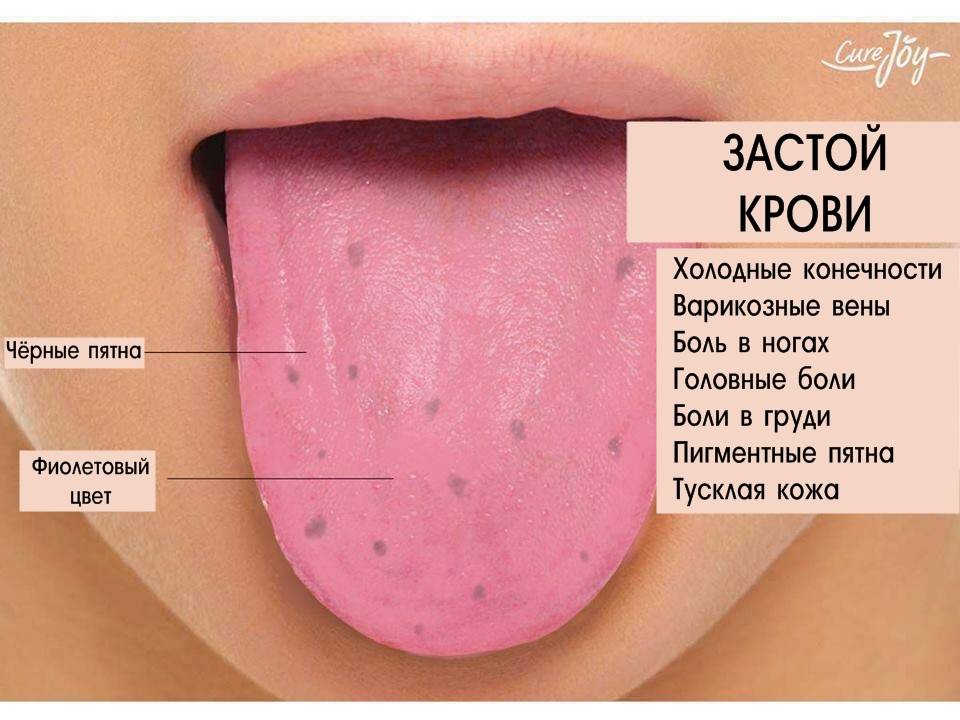 Горит язык во рту. причины покраснения, как лечить при всд, беременности, гастрите. отзывы