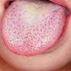 Кандидоз полости рта. причины, симптомы и признаки, лечение кандидоза. :: polismed.com