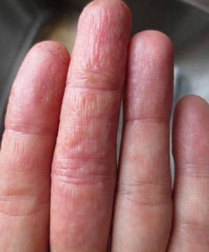 Пузырьки на пальцах рук: от чего появляются волдыри на коже