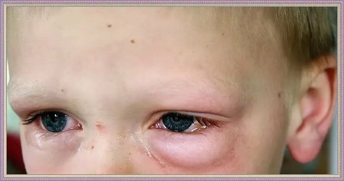 Красные глаза у ребенка: причины и лечение, что делать родителям