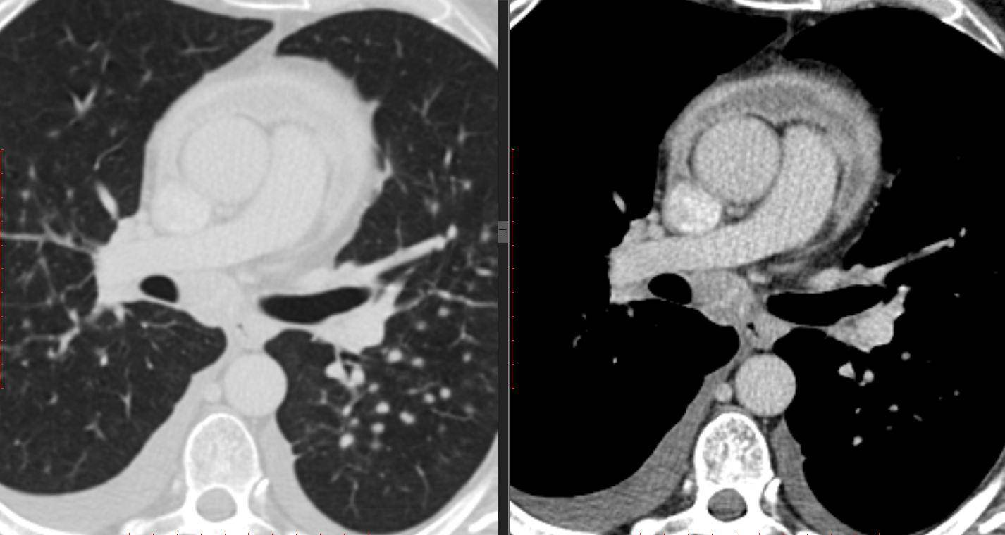 Мскт сердца и коронарных сосудов в москве: сделать мультиспиральную томографию с контрастом по выгодной цене в диагностическом центре цкб ран