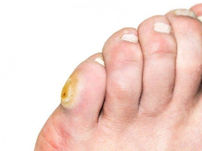 Твердая мозоль на пальце ноги - причины, методы лечения и профилактика