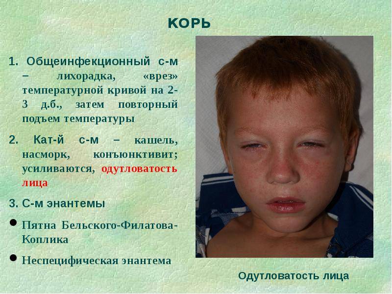 Скарлатина у детей: симптомы и лечение (17 фото)