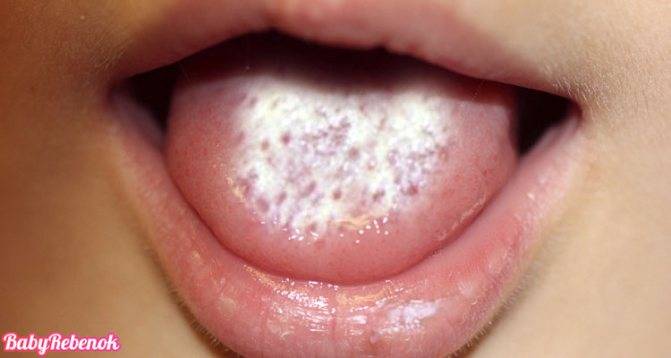 Кандидоз (молочница) полости рта: симптомы и методы лечения - много зубов