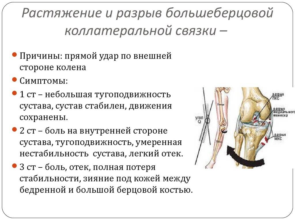 Повреждение коленной связки симптомы