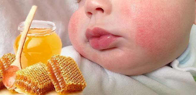 Как проявляется аллергия на глютен у детей и как ее лечить