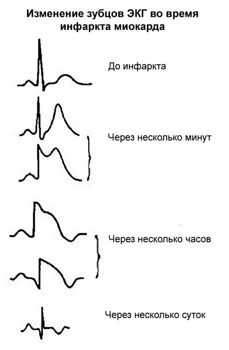 Может ли узи сердца показать предынфарктное состояние