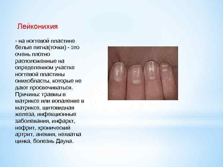 Почему у ребенка на ногтях появляются белые пятна