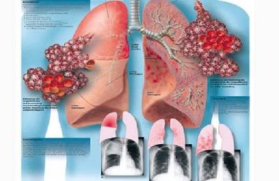 Причины и лечение двухсторонней пневмонии легких у взрослых