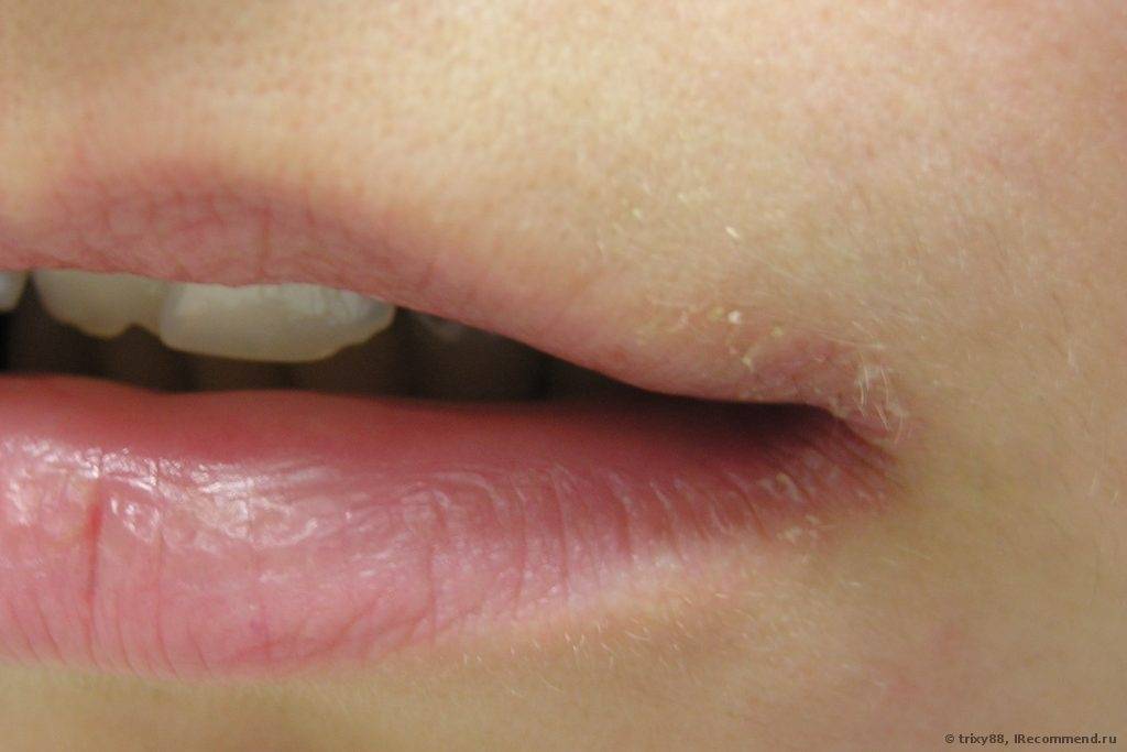 Заеды в уголках рта: причины, лечение трещин на губах