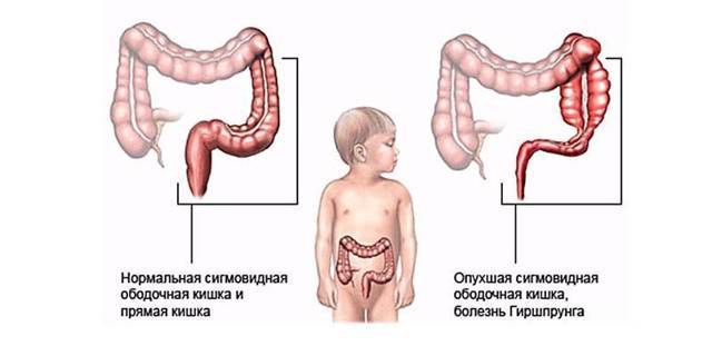 Долихосигма кишечника: лечение у взрослых и детей | компетентно о здоровье на ilive