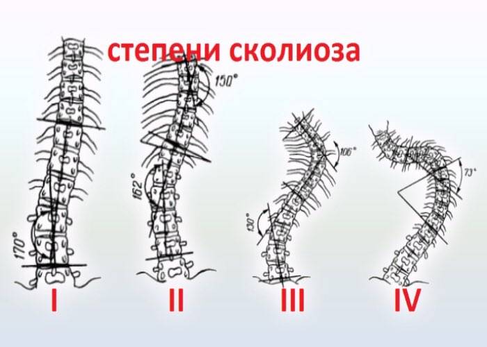 Степени сколиоза: характеристики, симптомы, лечение
