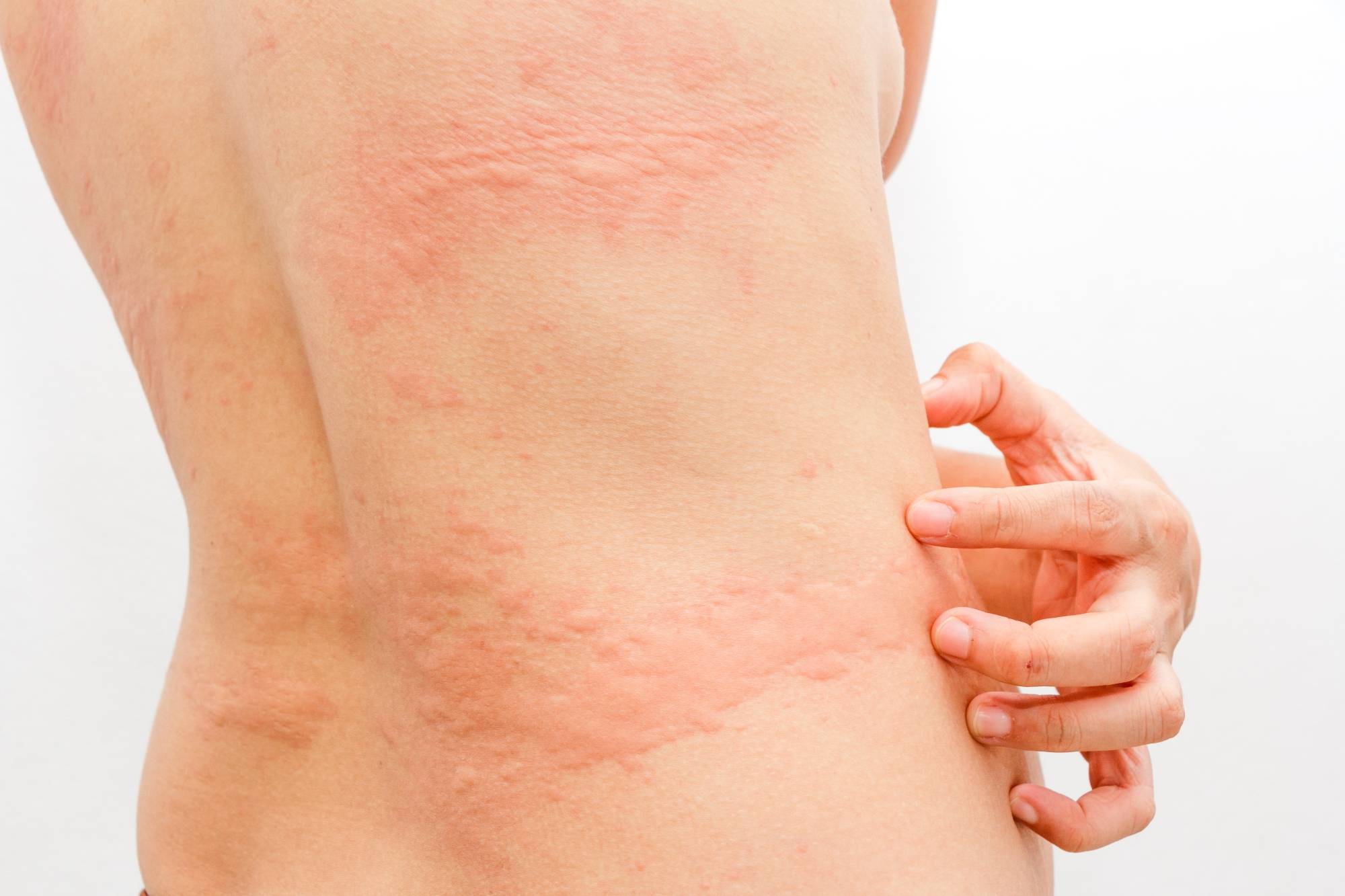 Проявления коронавируса: какие высыпания на коже должны насторожить