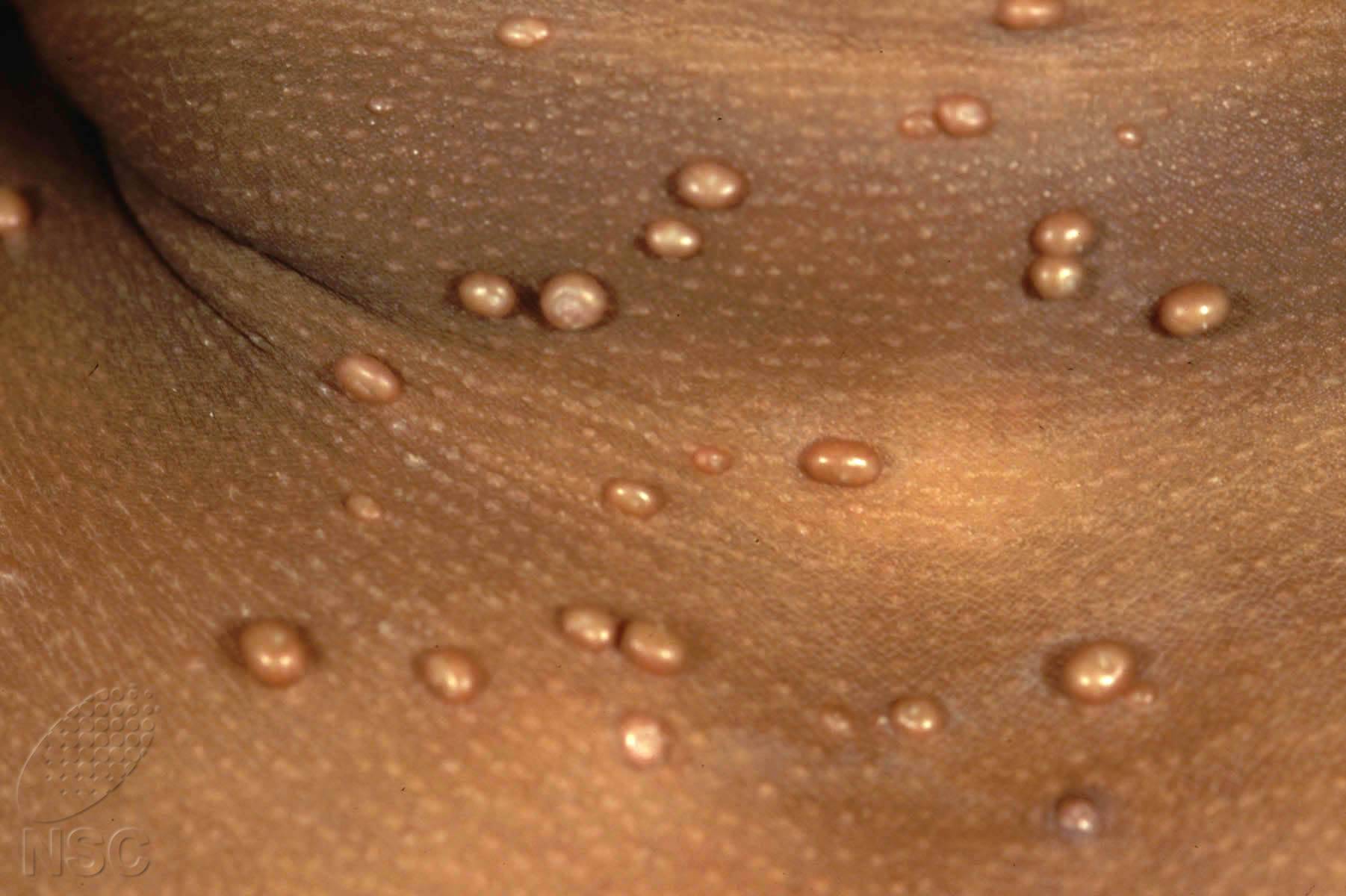 Что такое контагиозный моллюск и где он появляется? все, что вы хотели знать о данном заболевании.