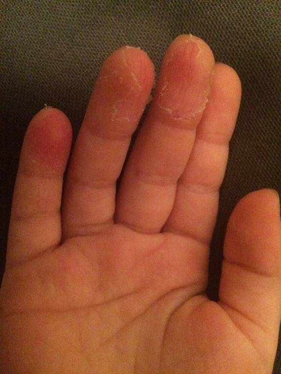 Шелушение кожи на ладонях рук: возможные причины и лечение
