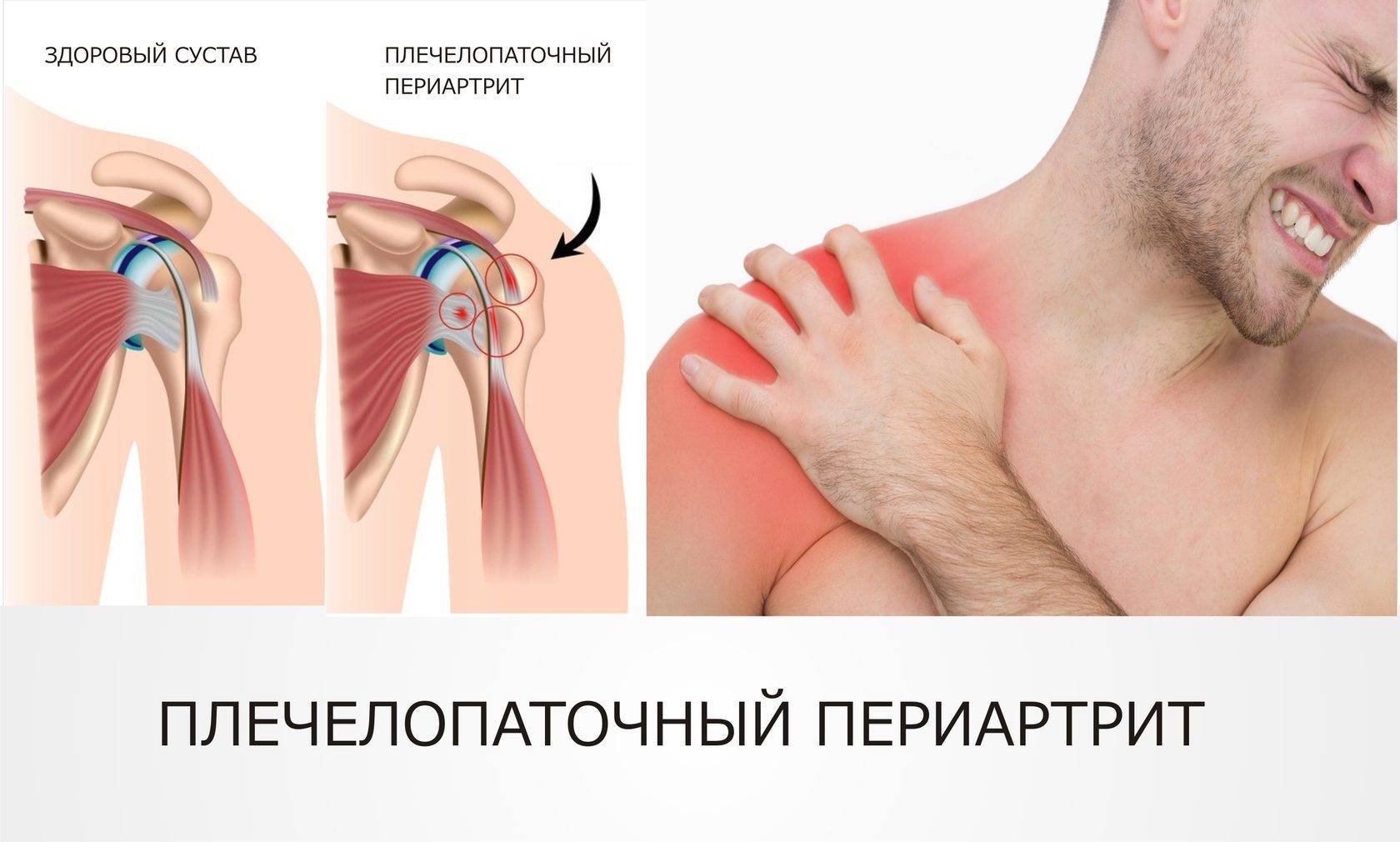 Синовит плечевого сустава: основные признаки заболевания