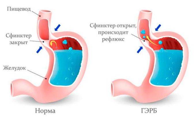 Кашель при рефлюкс-эзофагите: причины появления, лечение и отзывы