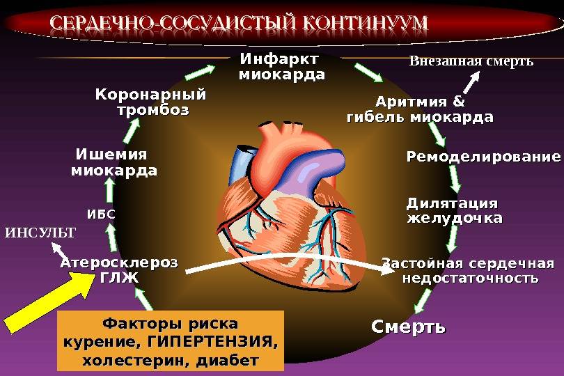 Аритмия и гипертония. Механизм развития острого инфаркта миокарда. ИБС острый инфаркт миокарда. Сердце анатомия инфаркт миокарда. Нарушение сердечного ритма при ИБС.