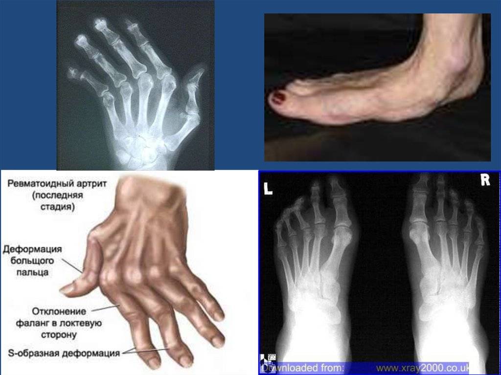Диагностика псориатического артрита - рентген и другие методы исследования