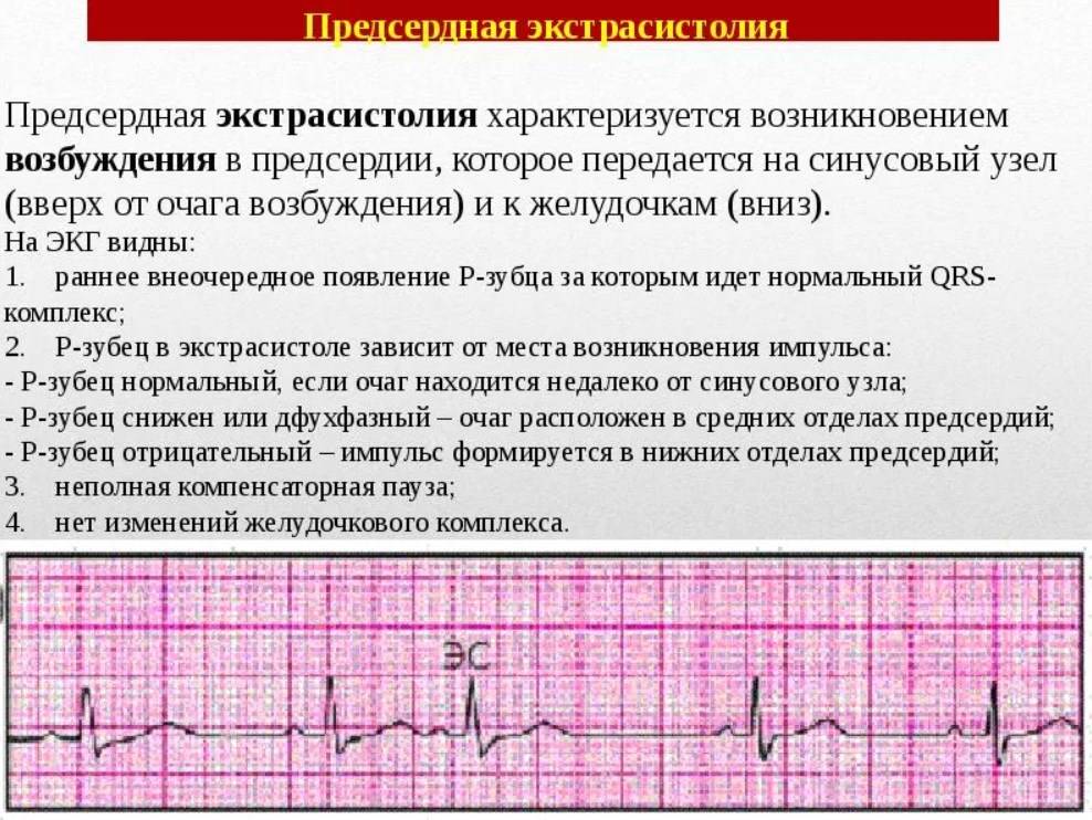 Мучают экстрасистолы, помогите - вопрос кардиологу - 03 онлайн