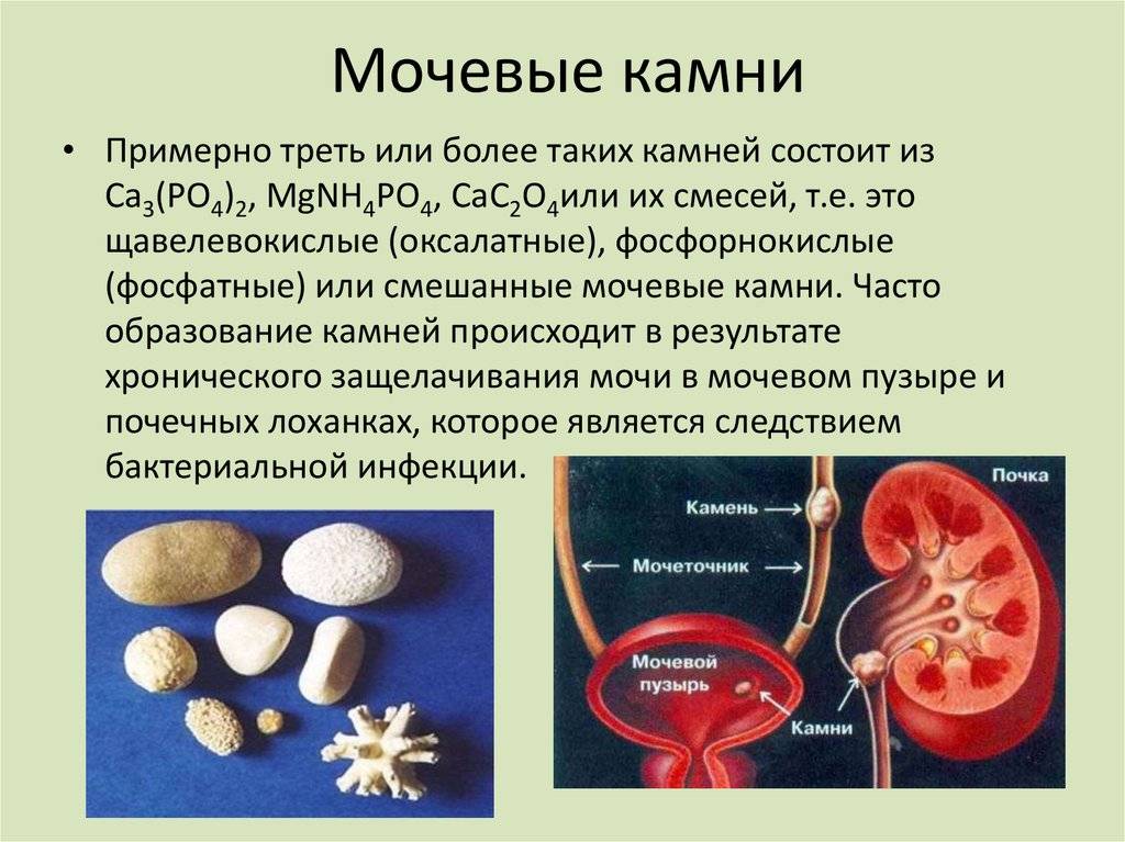 Камни в почках: лечение таблетками, разбивающими камни, обзор и правила применения эффективных уросептиков