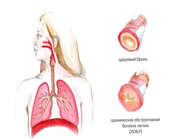 Слизь в горле и кашель: причины, диагностика, лечение